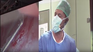 Live Surgery  Bladder Tumour Resection [upl. by Theobald468]