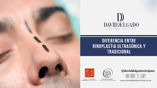 Rinoplastia Ultrasónica en Medellín  Dr David Delgado  Ciruano Plástico [upl. by Gatias]