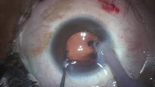 IPCL explantation plus Cataract surgery Dr Sourabh Patwardhan Live [upl. by Teeniv]