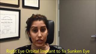 Right Eye Orbital Implant for Sunken Eye enophthalmos  Silent Sinus Syndrome Treatment [upl. by Brunhilda]