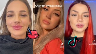 Lip Filler TikTok Compilation  LIP FILLER Check 👄 ✨ [upl. by Obadias]