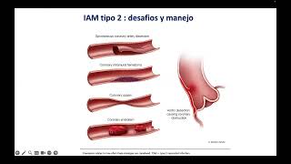 Infarto Agudo de Miocardio tipo 2 desafíos y manejo Dr Helio Guimaraes [upl. by Jueta]