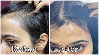 Best Hair Serums For Reduced Hair fall and Hair Growth [upl. by Jehias687]