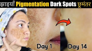 In 14 Days 💕Remove झाइयाँ Blemishes Pigmentation Dark Spots Naturally amp Get Clear Glowing Skin [upl. by Baoj]