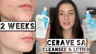 TESTING CERAVE SA CLEANSER amp LOTION ON MY DRY ACNE SKIN FOR 2 WEEKS [upl. by Sibella]