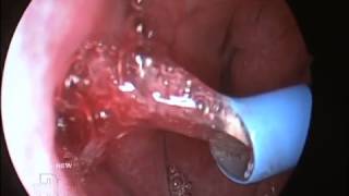 Eustachian Tube Surgery  The Drs Tv Sh0w [upl. by Quiteria]