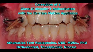 Class II Correction with the Carriere  Athanasios Tom Nasiopoulos [upl. by Bosson]