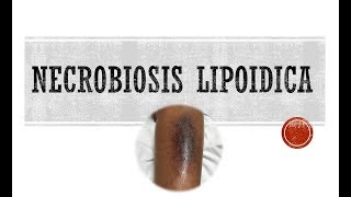 Necrobiosis Lipoidica [upl. by Zemaj]