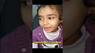 Intermittent Exotropia [upl. by Janela]