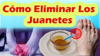 Como Eliminar Los Juanetes De Forma Natural COMO CORREGIR LOS JUANETES SIN CIRUGÍA [upl. by Rorie]