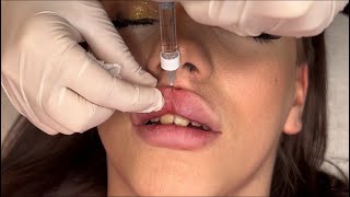 How to Safely Inject Lip Filler for Best Results [upl. by Houser]