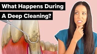 What Happens During a Deep Cleaning Procedure Scaling and Root Planing [upl. by Loretta166]