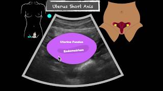 POCUS Female Pelvis Transabdominal scanning sequence [upl. by Coh]