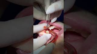 Lower lateral incisor extraction for Invisalign [upl. by Kalam]