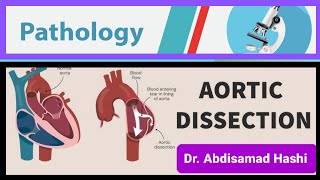 73 Aortic Dissection amp Aneurysm [upl. by Akered287]