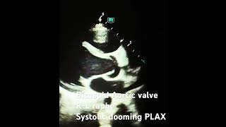 Bicuspid aortic valve with RL coronary cusps fusion cardiology echocardiography medicine [upl. by Sicular]