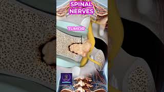 Vertebral Cancer In Spinal Nerves shorts animation [upl. by Apurk58]