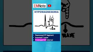 Electrolytes ECG Changes medical doctor nursing [upl. by Woodcock161]