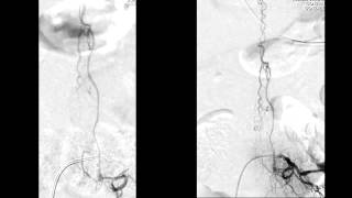 Endovascular treatment of a spinal dural arteriovenous malformation DAVF [upl. by Jodi844]