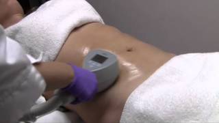 Exilis ELITE Skin Tightening Treatment  Moradi MD [upl. by Orlando]