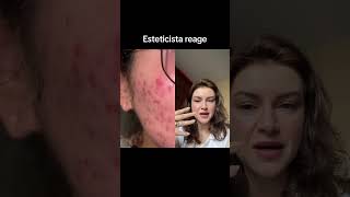 Esteticista reage a adesivo hidrocoloide [upl. by Sande231]