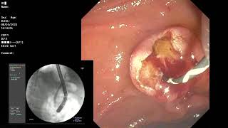 ERCP  Simple cannulation technique for ERCP by upscope maneuver after tip of catheter engaged [upl. by Suiratnauq843]