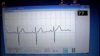 Wireless EKG [upl. by Nerraj]