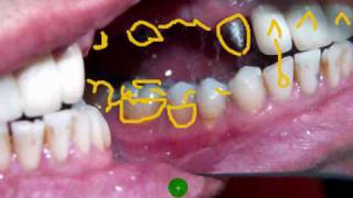 Edident Lab quotDental Upper six unit Porcelain Buildup Part 1quot [upl. by Nyvrem]