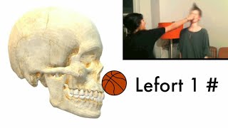 Lefort 1 Fracture  Gurein Sign  Floating Maxilla  Telescopic Fracture  Aspire MDS  Dr Bhaumik [upl. by Danit]