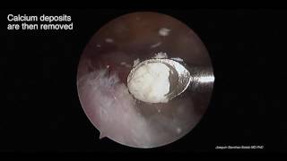 Arthroscopic removal calcific tendonitis [upl. by Leibarg]