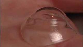 Scleral Contact LensesMayo Clinic [upl. by Floss]