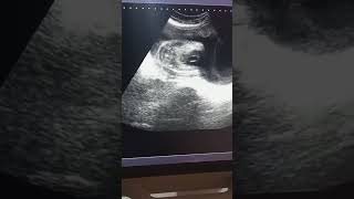 Baby boy ultrasound [upl. by Atinuhs]