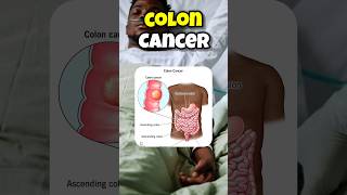 colon cancer symptoms shorts [upl. by Bedelia977]