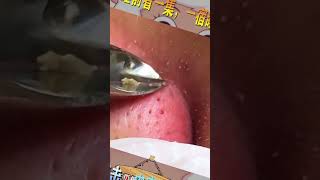 Blackhead Removal Acne Removal Treatment 030 [upl. by Meli]