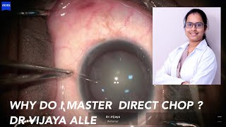 DIRECT CHOP  IMMATURE CATARACT  DR VIJAYA ALLE [upl. by Hermione]