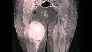 Synovial Sarcoma Thigh [upl. by Sivra]