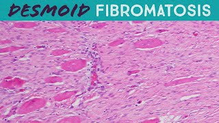 Desmoid Tumor Fibromatosis explained in 5 minutes pathology usmle FAP familial adenomatosis coli [upl. by Estrellita]