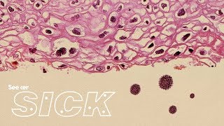 This Is How HPV Causes Cancer [upl. by Renckens]