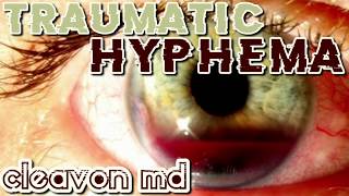 Cleavon MD  Traumatic Hyphema [upl. by Marven]