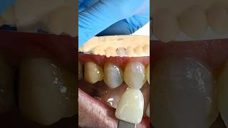 Signature Premolar ​⁠EnvisiontecMain envisiontec lsk121shorts dentistteeth [upl. by Ahtenek653]