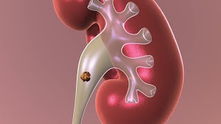 ESWL Extracorporeal Shock Wave Lithotripsy Surgery for Kidney stones explained [upl. by Htirehc]