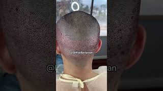 Hairline restoration FUE hair transplant performed by Dr Rob Berberian in LA amp Newport Beach [upl. by Gunther]