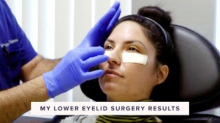 Real Lower Blepharoplasty Recovery amp Results  In the OR Part 3 of 3 [upl. by Sasnett]