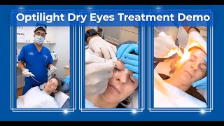 IPL Treatment for Dry Eyes amp Inflammation Rosacea Styes MGD  Lumenis Optilight [upl. by Mari]