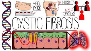 Understanding Cystic Fibrosis Includes Pathophysiology amp Diagnosis [upl. by Ulric]