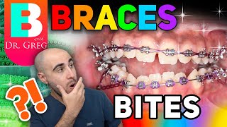 Braces Overbite Overjet Underbite Crossbite amp Open Bite Explained [upl. by Etireuqram]