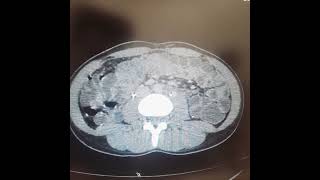 Ct Enterography with IV contrast [upl. by Enymsaj345]