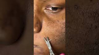 Trimming dead skin  Chemical Peel  Hyperpigmentation Removal [upl. by Rutger]