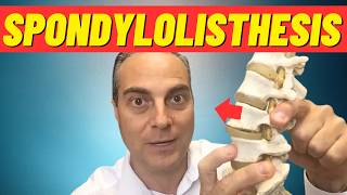 What Is Spondylolisthesis What Is Anterolisthesis Dr Walter Salubro Chiropractor in Vaughan [upl. by Suivatnod]