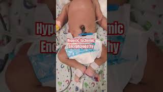 HypoxicIschemic Encephalopathy  what is HIE in newborn HIE seizures hypoxia [upl. by Nabru]